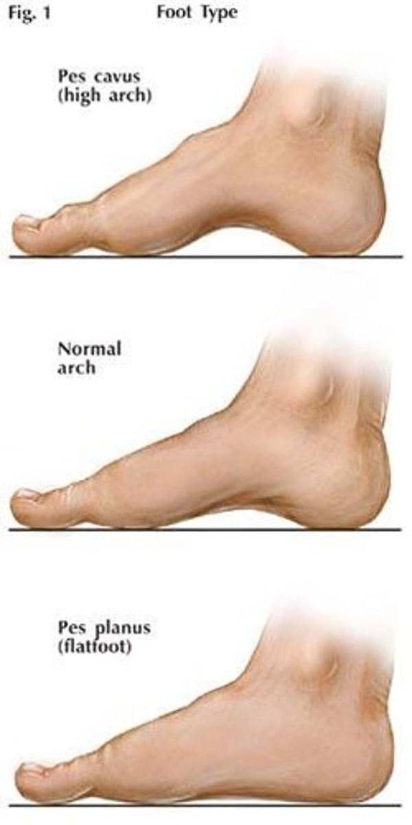 <p>Pes Planus (flat foot)</p><p>Foot Pronation &amp; Calcaneal Eversion</p><p>Associated with genu valgum and Femoral anteversion</p><p>Pes planus is usually hypermobile, so we have more excessive rearfoot and forefoot motion during gait. Places excessive stresses on soft-tissue structures during power and agility activities.</p><p>Pes Cavus (high arch)</p><p>Foot Supination</p><p>Associated with hammertoes and Femoral retroversion</p><p>Pes Cavus produces less mobility of the rearfoot and forefoot. It's ability to absorb stresss is decreased, so the probability for stress fractures is increased</p>