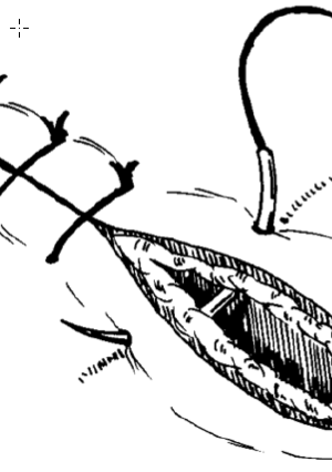 <p>What suture pattern is shown in the image?</p>