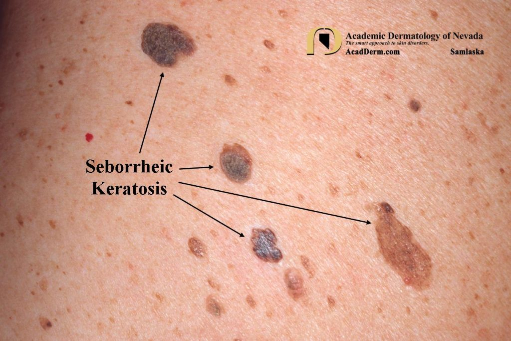 <p>E: very common</p><p>CM: papule<br>-dry<br>-raised<br>-“stuck on”<br>-tan/brown/black<br>-sharply demarcated</p><p><u>Lesar Trelat sign:</u> sudder appearance of multiple SKs→internal malignancy</p><p>TX: cryotherapy<br>curettage</p>