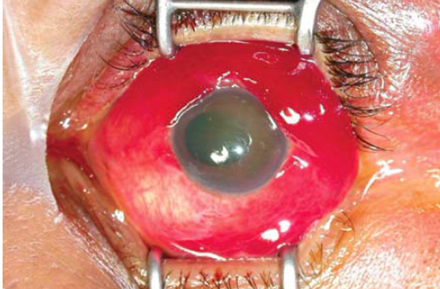 <p>Markedly decreased visual acuity, relative afferent pupillary defect, teardrop pupil, external prolapse of the uvea or ocular structures, tenting of the cornea or sclera, Seidel sign (fluid leaking), and subconjunctival hemorrhage or hyphema.</p>