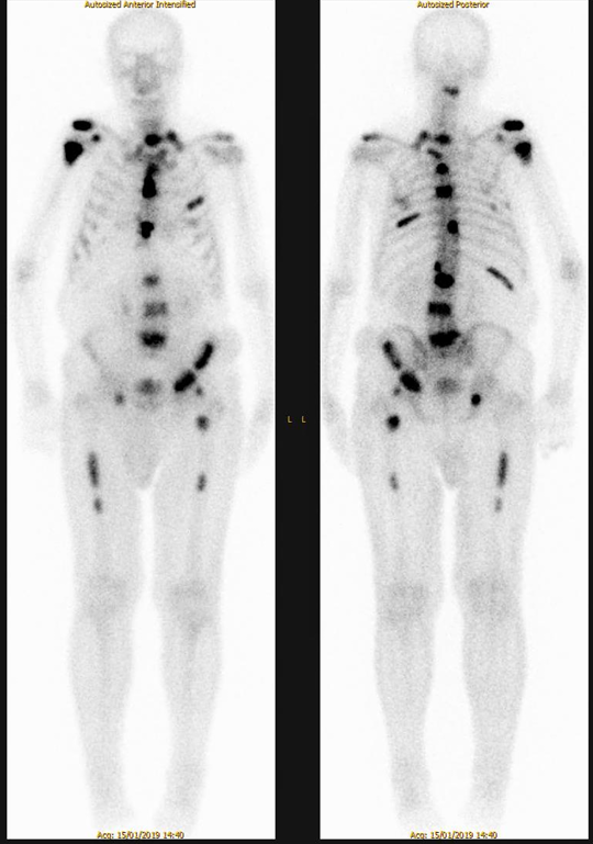 <p>Patient history: history of prostate cancer, elevated PSA level at present </p><p>Modality: bone scintigraphy with 99mTc withmethylene diphosphonate(MDP) radiotracer </p><p>Region: whole body, AP and PA views </p><p>Radiologic sign: multiple foci of increased radiopharmaceutical uptake in the bones </p><p>Diagnosis: multiplex osseal metastases, scoliosis</p>