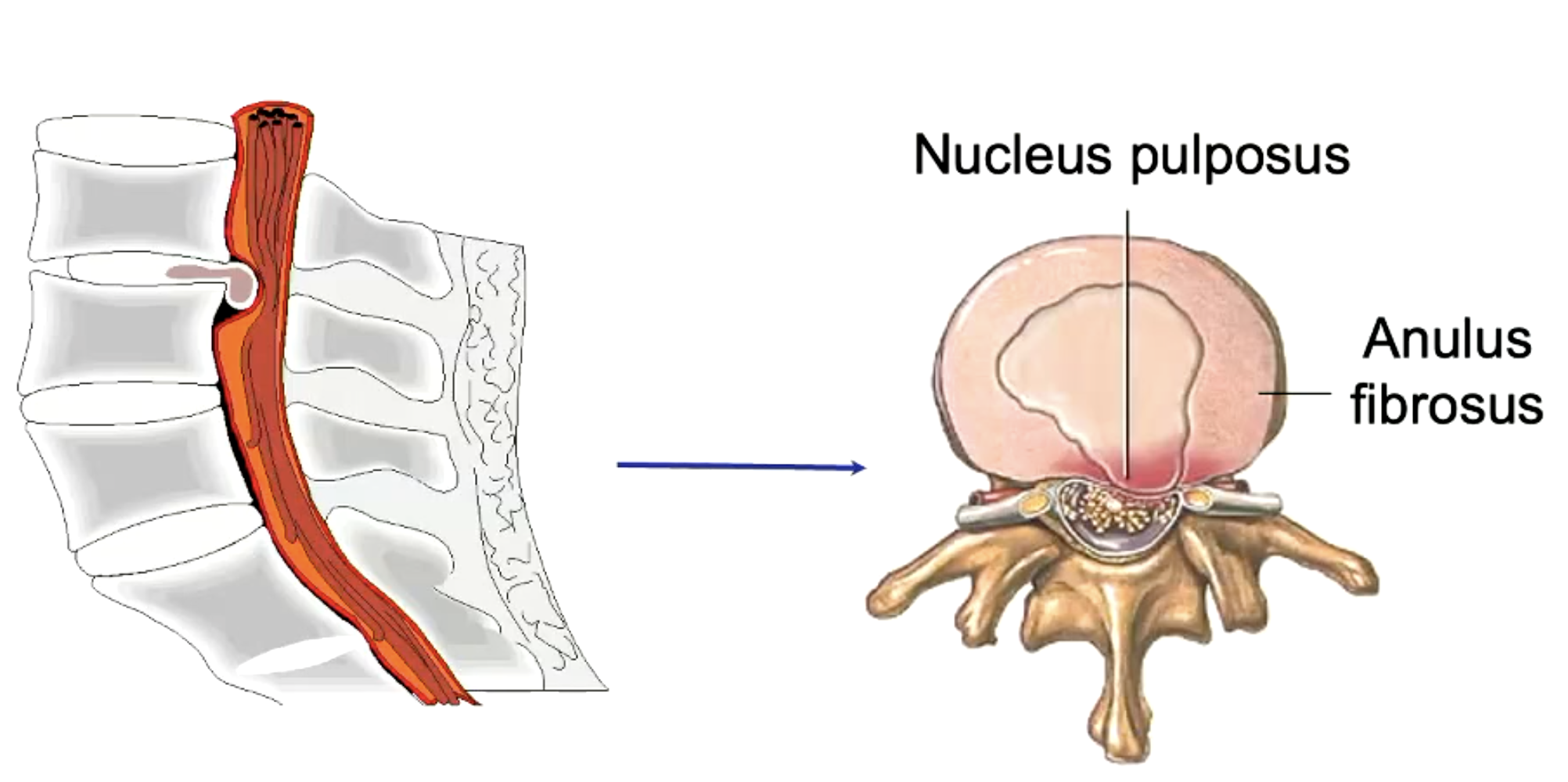 <p>herniated disc</p>