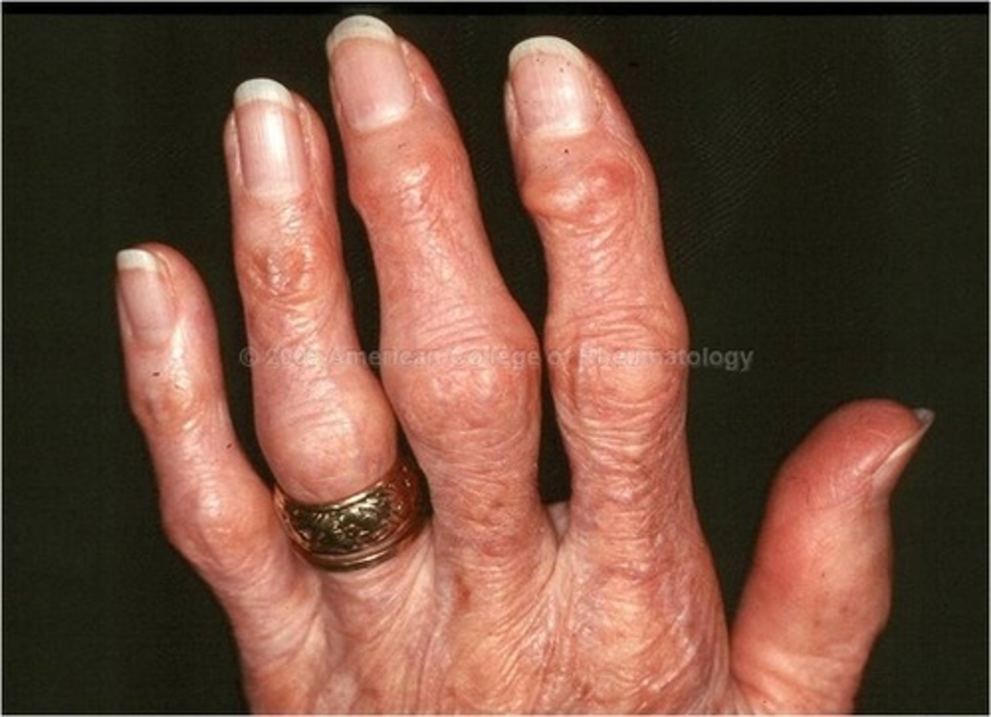 <p>rheumatoid arthritis</p>
