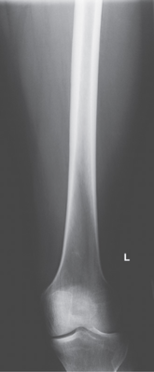 <p>- Rotate leg 5° internally</p><p>- CR to midpoint of IR</p><p>- Knee joint included</p><p>- No rotation</p><p>- From knee joint up as high as you can get on IR.</p>