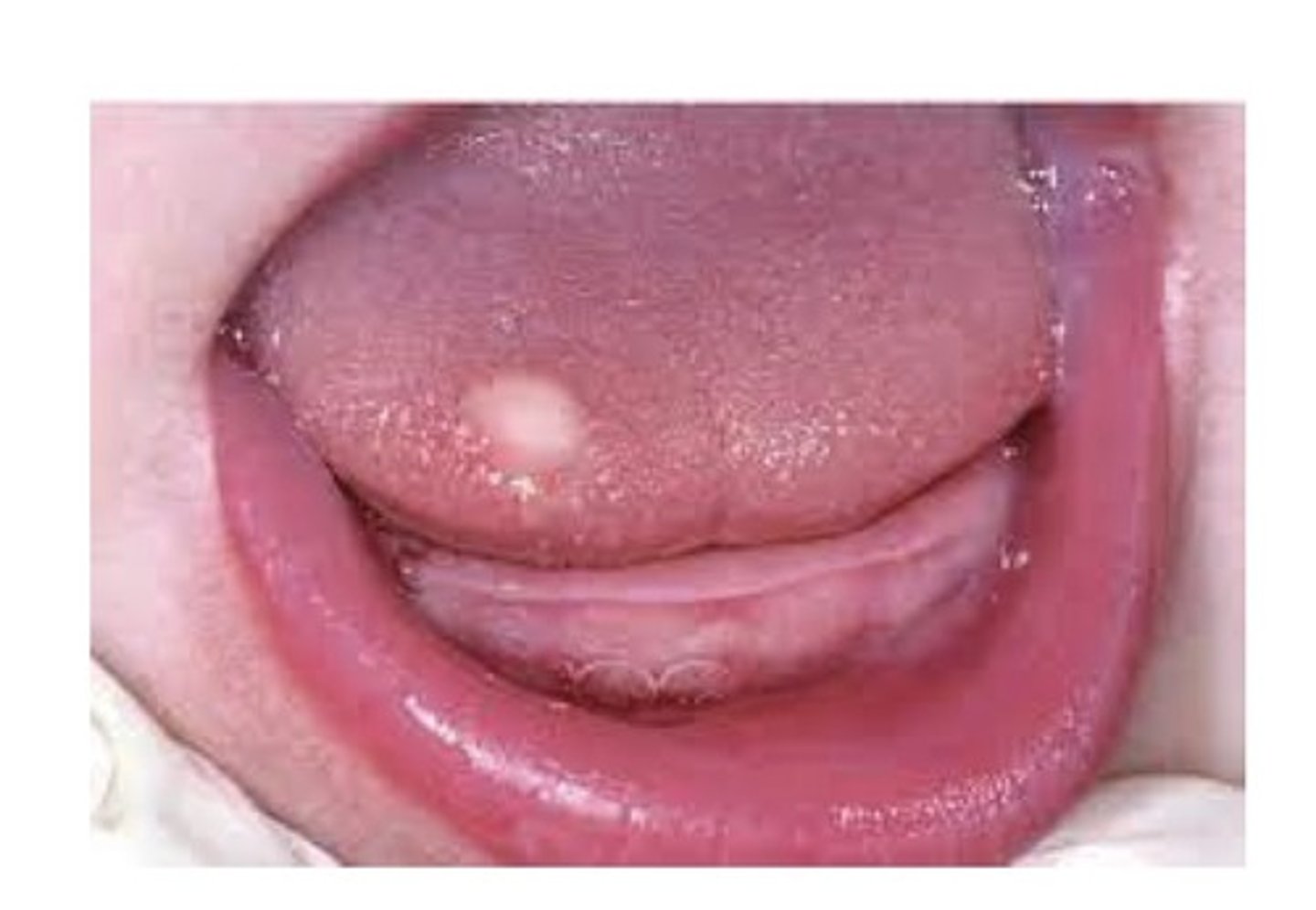 <p>A benign tumour composed of large cells with a granular cytoplasm. Most often occurs on the tongue, followed by the buccal mucosa. A painless, non ulcerated nodule. Most are found in adults, with a female sex predilection.</p>