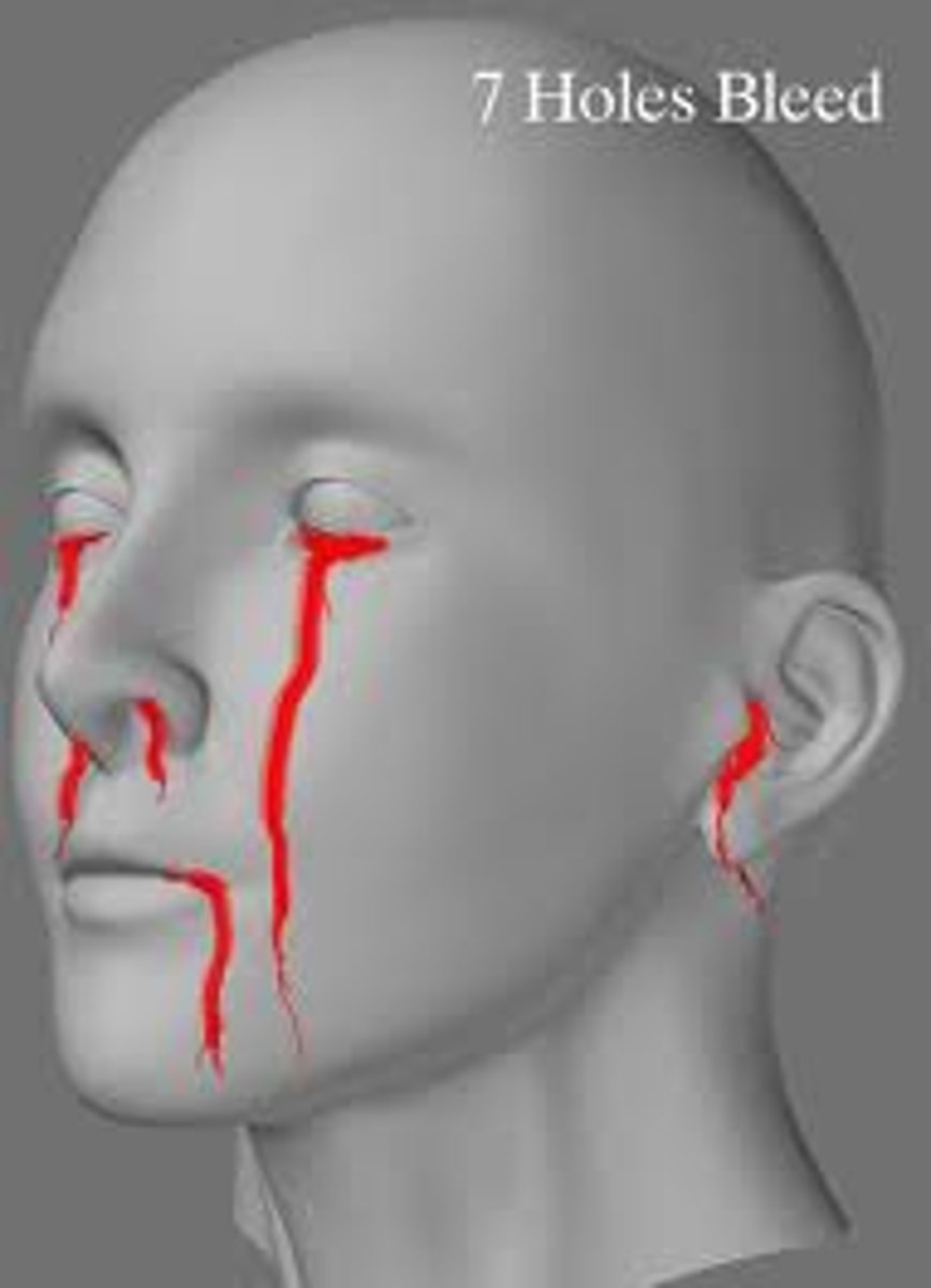 <p>bleeding from ears, nose, mouth or eyes, coughing up blood, bruises near skin surface</p>