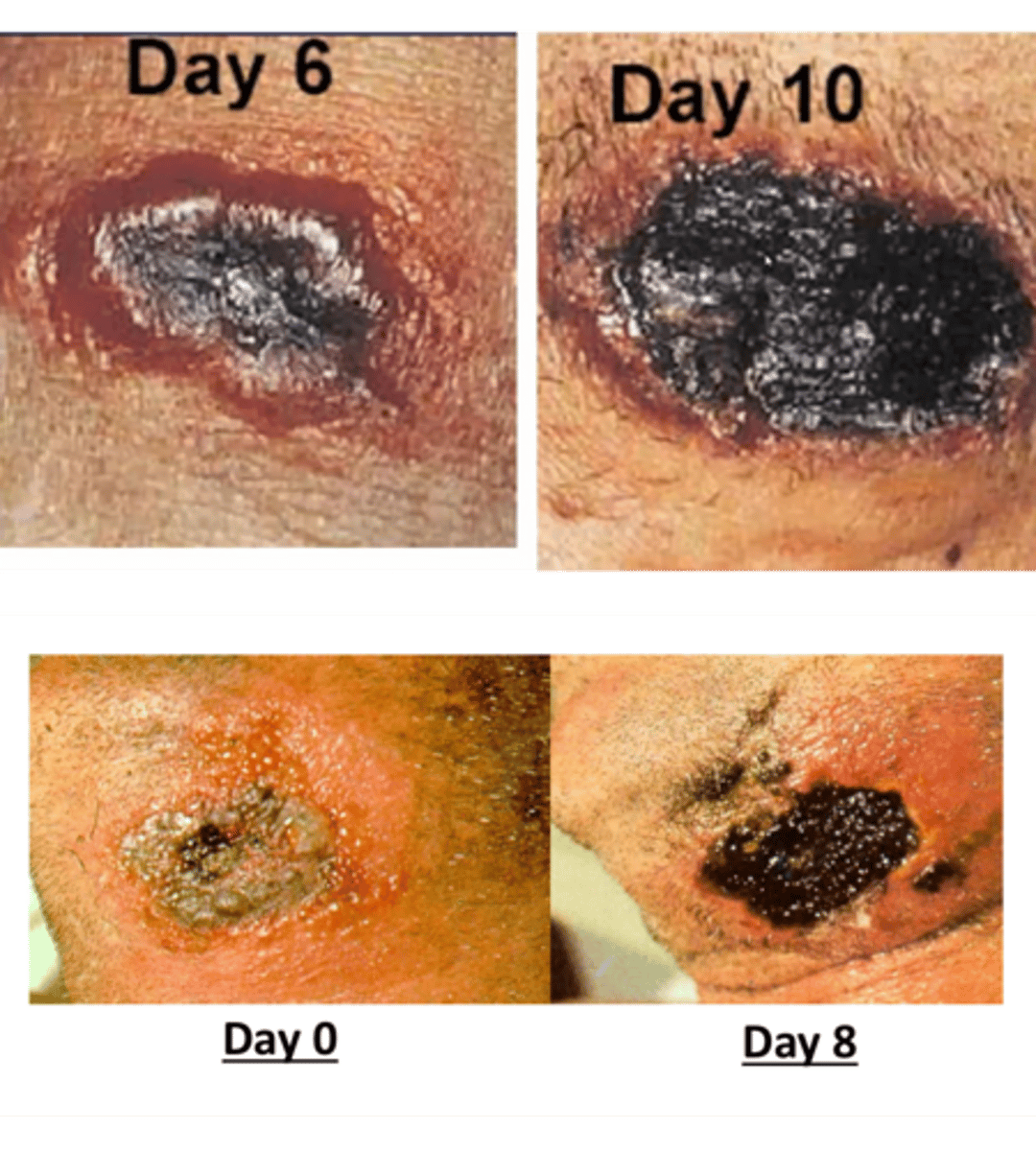 <p>Painless black necrotic lesion</p><p>- least dangerous type of anthrax</p><p>- papule that grows into necrotic eschar</p><p>- category a bioterrorism agent</p>