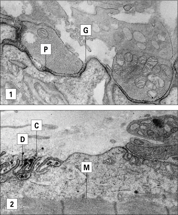 <p>TYPE 2 HYPERSENSITIVITY</p><p>target the acetylcholine receptor and inhibits binding, causing paralysis and muscle weakness</p>