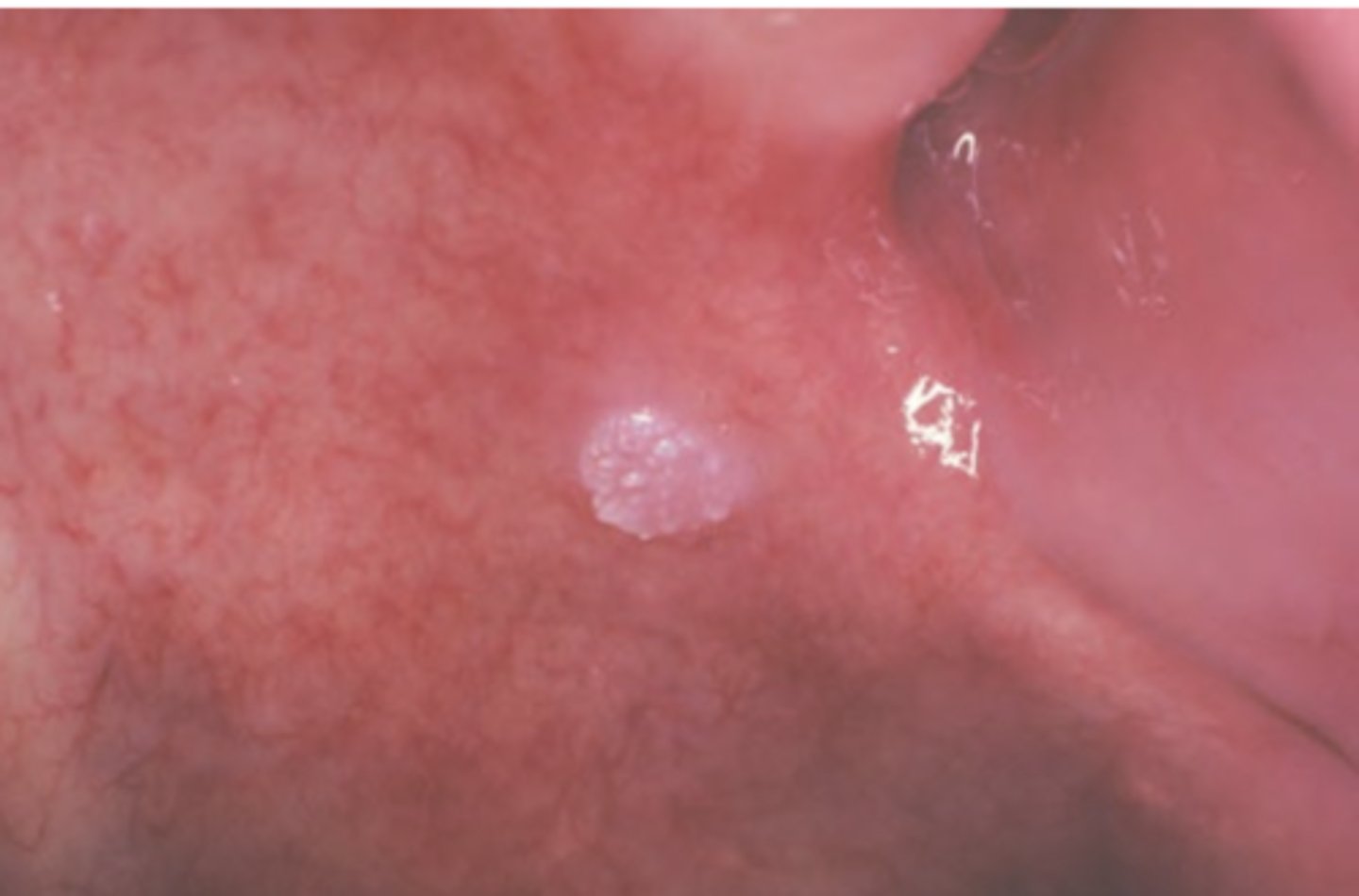 <p>Hint: HPV types 6 & 11 involved</p>