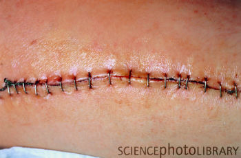 -Wound is clean, in a straight line, with little loss of tissue
-All wound edges are well approximated with sutures
-usually rapid healing with minimal scarring

Would occur after surgical incision.