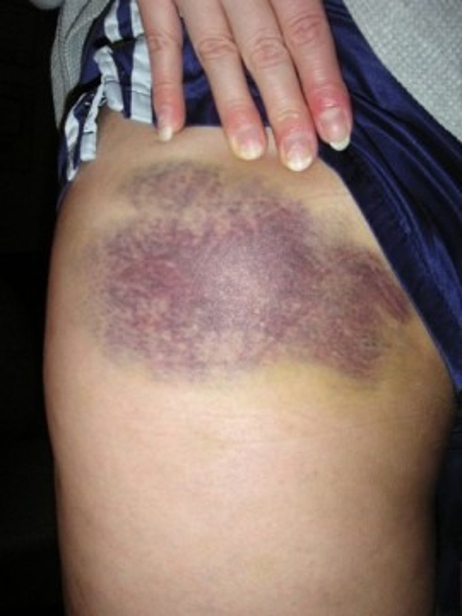 <p>1. ecchymosis</p><p>2. epistaxis</p>