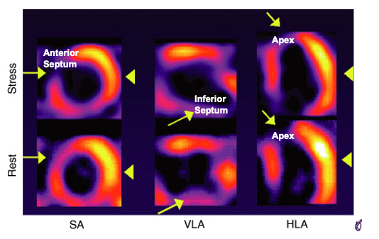 <p>How does this SPECT Scan show abnormalities? </p>