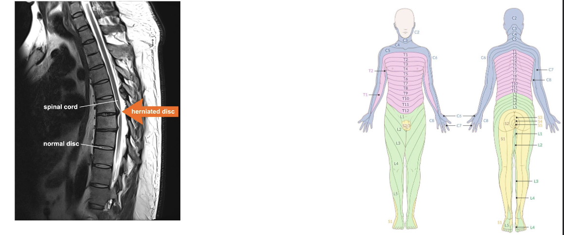 <p>Physical exam, Imaging, and/or even nerve tests for diagnosis</p><ul><li><p><span><span>Herniated discs cause localized and radiating pain by compressing the spinal cord or nerve roots, with pain location often indicating the affected level</span></span></p></li></ul><p></p>