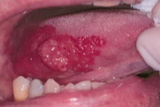 <p><span>the </span><span style="color: red;"><span>most common</span></span> oral malignancy</p><p>differentiating this from benign lesions with similar features can be challenging</p><ul><li><p><strong>clinical considerations:</strong></p><ul><li><p>early detection and treatment is the key for survival</p></li><li><p>oral healthcare providers are best qualified to examine oral tissues and identify suspicious lesion</p></li><li><p>any suspicious lesion, especially in patients with common risk factors,<span style="color: red;"> must be biopsied </span>due to the <span style="color: red;">morbidity and mortality</span> associated with SCC</p></li></ul></li></ul><p></p>