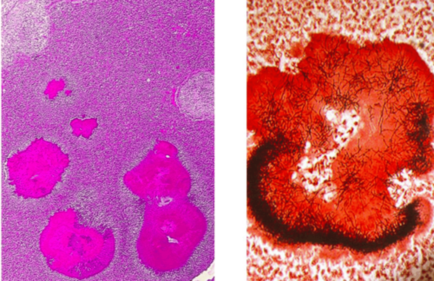 <p>- BRANCHING FILAMENT</p><p>- Live in MOUTH FLORA</p><p>- Cause CHRONIC INFECTION w mouth, bites</p><p>- In colonies surrounded by SULFUR GRANULES (calcifed macrophages)</p><p>DISEASE:</p><p>- In Cow: LUMPY JAW DZ: Mandible Suppurative osteomyelitis (trauma/teething associated)</p><p>DX: Gram-stain, sulfur granules</p><p>TX:</p><p>- Since chronic and walled-off micro-colonies =&gt; Hard to treat</p><p>- SX + Antimicrobials long-term</p>