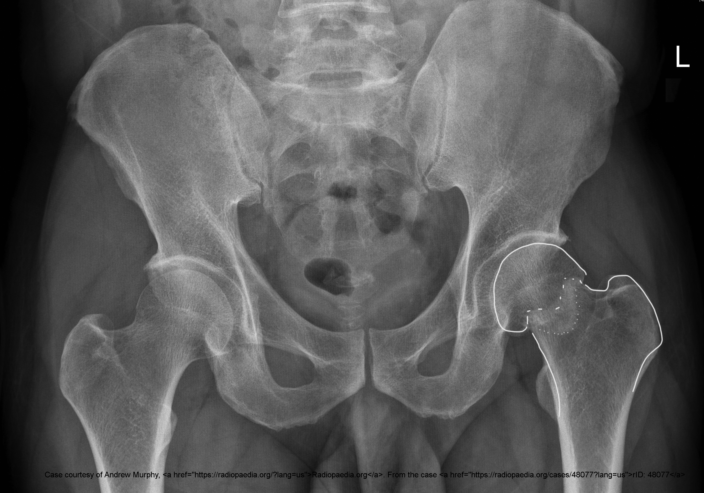 <p>Just below the femoral head.</p>