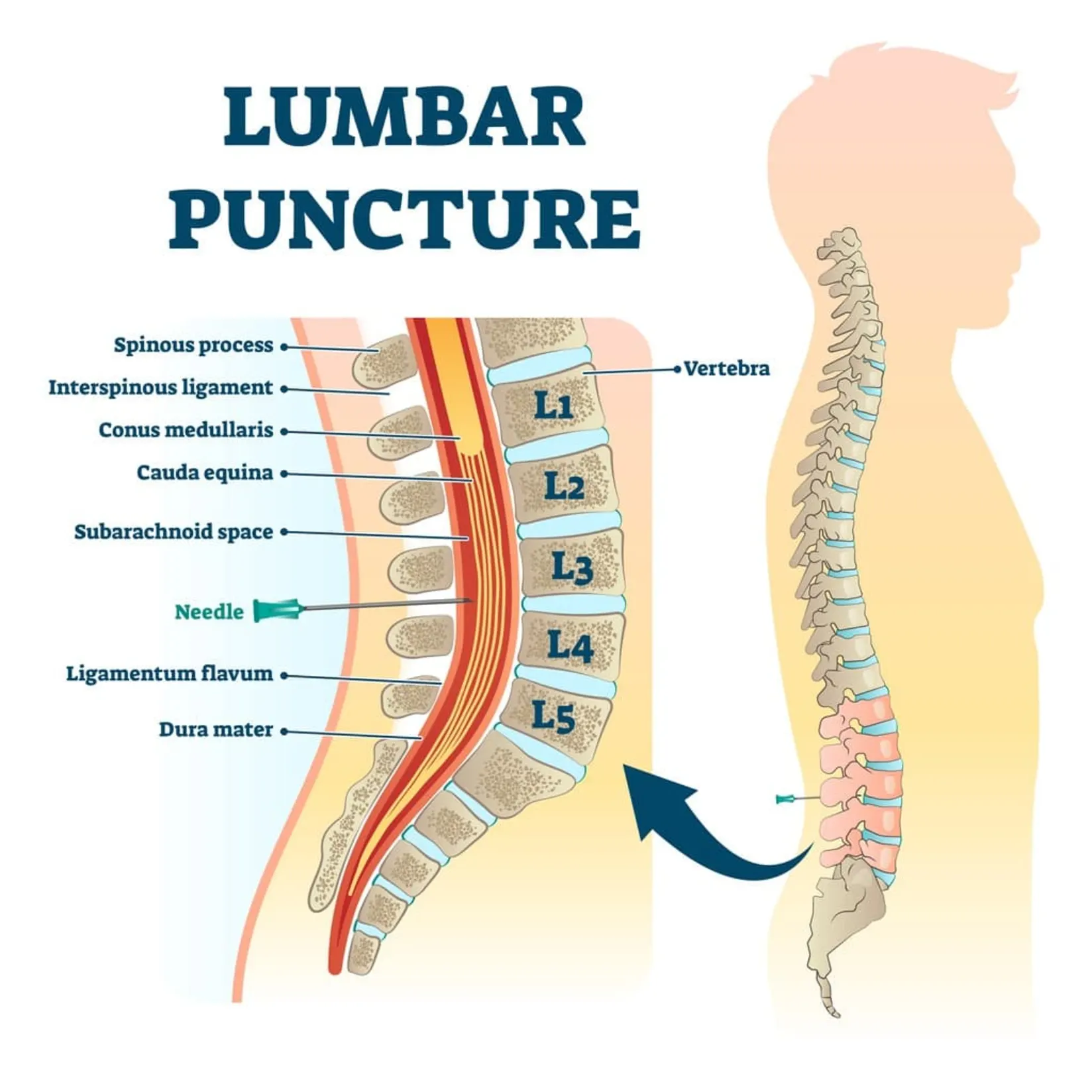 <p>L3/L4 into the subarachnoid space.</p>