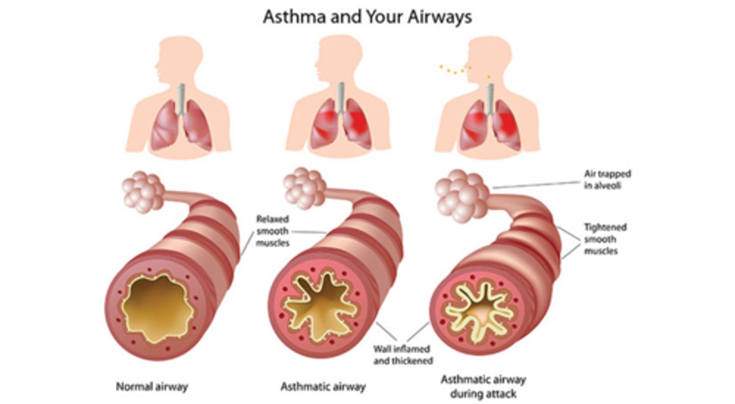 <p>- Signs: dyspnea (SOB)</p><p>- Symptoms: wheezing and cough</p>