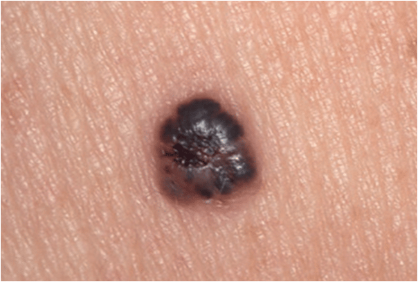 <p>Rapid growth, more aggressive melanoma</p><p>Spreads vertically, so tumor is thicker (deeper) </p><p>Any site, trunk, head, neck</p>