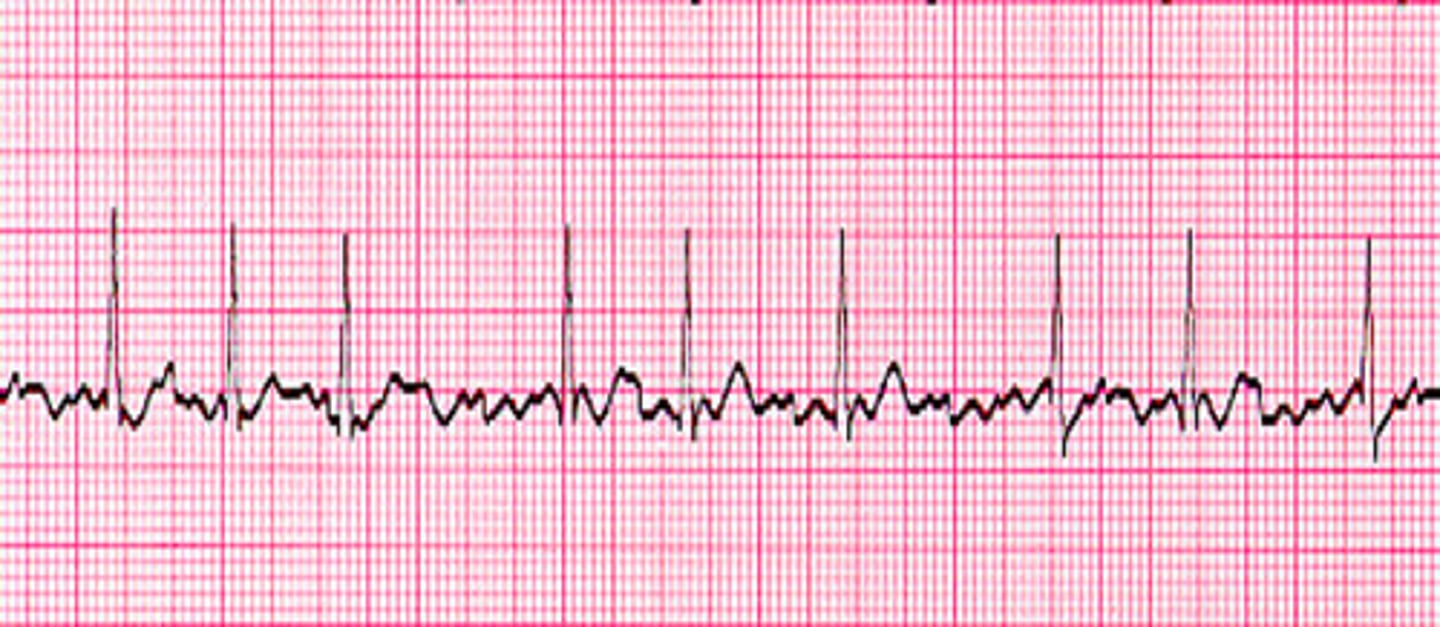 <p>What does the ECG show?</p>