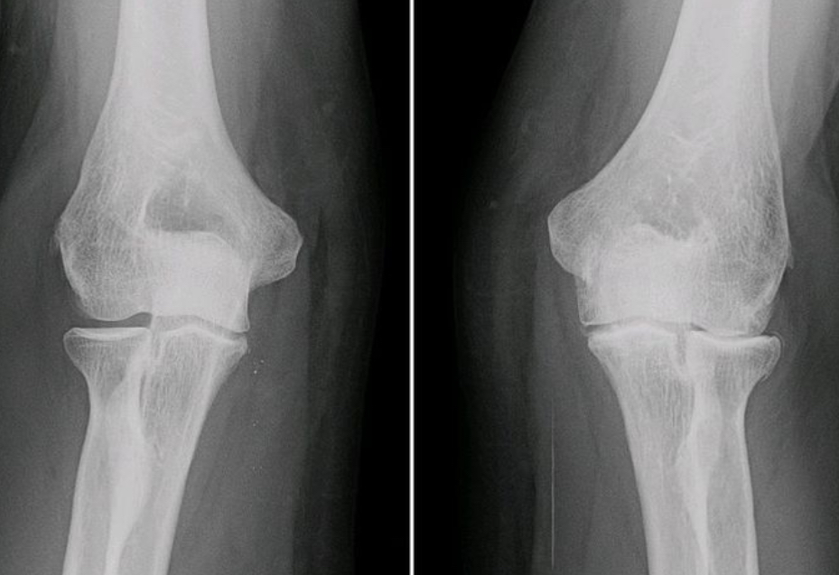 <p>Typical findings can be remembered with the mnemonic "LOSS":</p><ul><li><p>Loss or narrowing of joint space due to thinning of cartilage</p></li><li><p>Osteophytes i.e. formation of new bony spurs at the joint margins</p></li><li><p>Subchondral sclerosis i.e. increased bone density beneath the cartilage</p></li><li><p>Subchondral cysts which are fluid-filled sacs in the subchondral bone</p></li></ul><p></p>