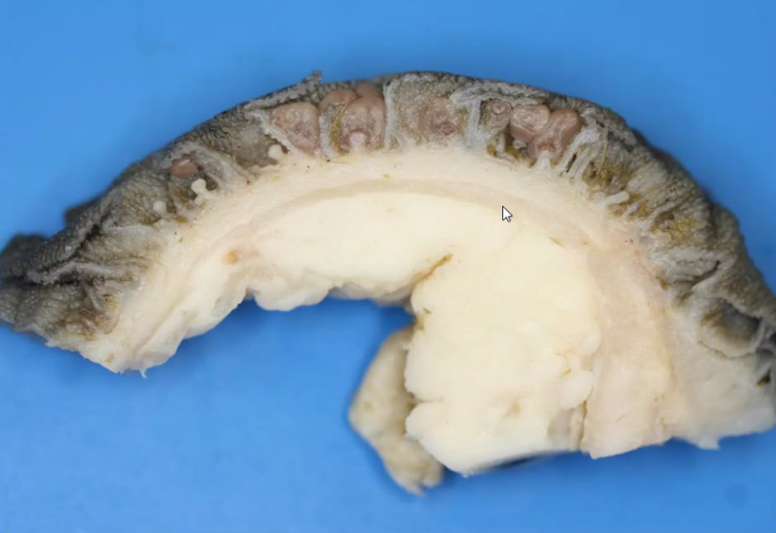 <p>What 'is the etiology?</p><p>A-Paramphistomum spp.</p><p>B-Fasciola hepatica</p><p>D-Fascioloides magna</p><p>E-Dicroe/ium dendriticum</p>