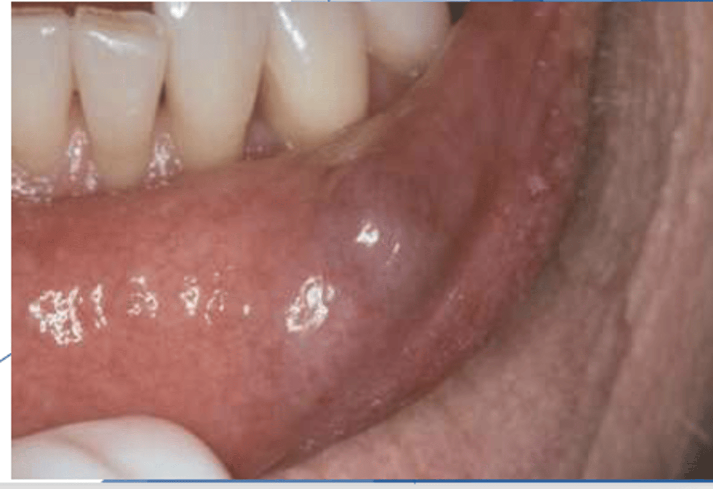 <p>These are clinical features of what pathology?</p><p>- Dome-shaped fluctuant vesicle</p><p>- <strong>Blue or mucosa</strong>-colored</p><p><u>- Most common on lower lip</u></p><p>- - May be seen anywhere w/ salivary glands</p>