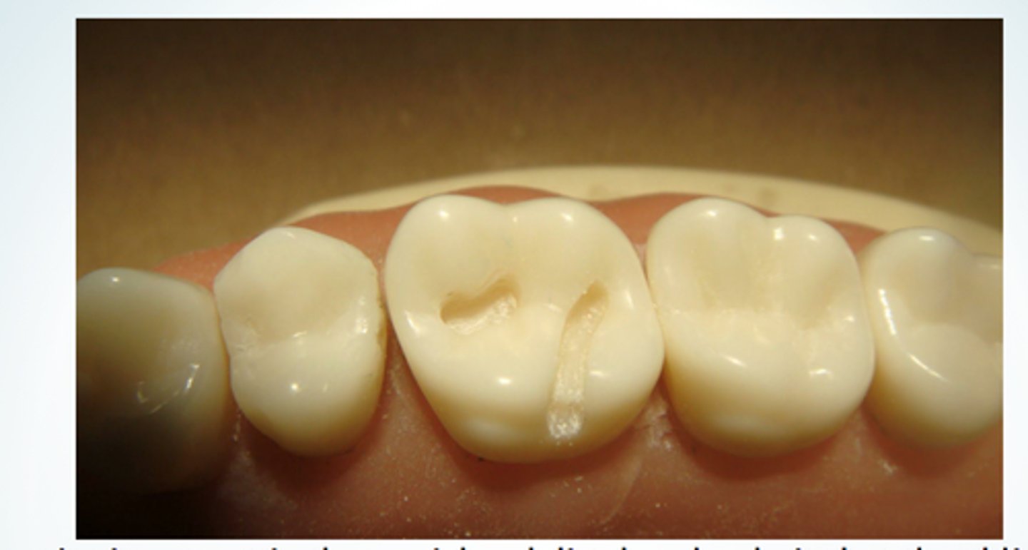 <p>do two DISTINCT prep (not connected) to preserve the oblique ridge</p>