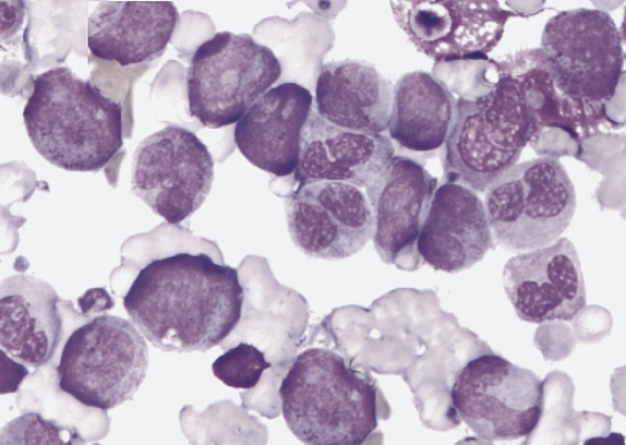 <p>which AML translocation is associated with the following information:</p><ul><li><p>5% of AML cases</p></li><li><p>predominantly in children and young children</p></li><li><p>myeloblasts with dysplatic granular cytoplasm, auer rods, and some maturation (similar to FAB M2 phenotype)</p></li><li><p>pseudo-pelger-huet cells and hypogranulation&nbsp;</p></li><li><p>eosinophilia may be seen&nbsp;</p></li><li><p>this diagnosis of the subtype is based on the genetic abnormality, regardless of blast count</p></li></ul><p></p>