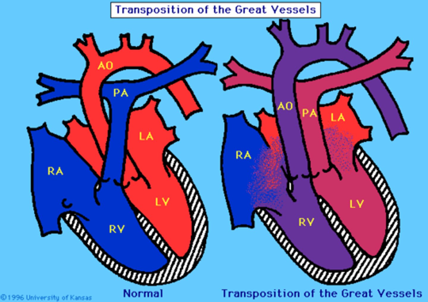 <p>aorta leaves RV (anterior) instead of LV (posterior) and pulmonary trunk leaves LV instead of RV, results from failure of aorticopulmonary septum to spiral</p>