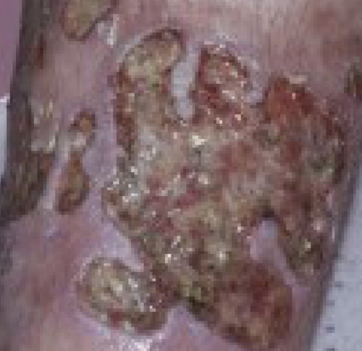 <p>Loss of the epidermis and dermis</p>