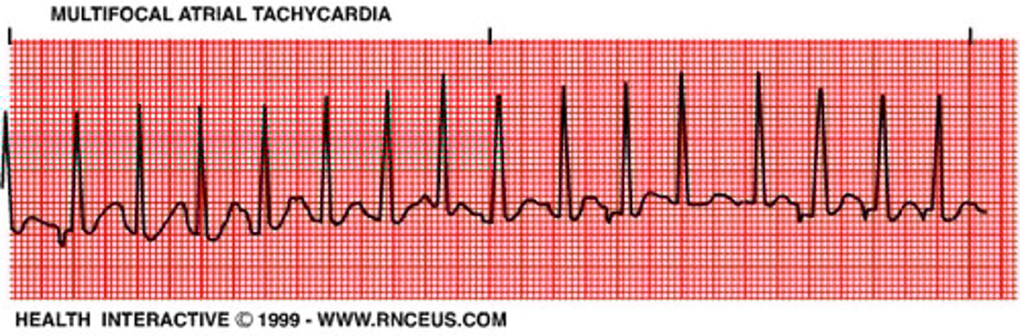 <p>- impulse originates at diff places in atria so P waves diff and intervals might not be consistent</p><p>- assoc w/ severe pulm dz</p>