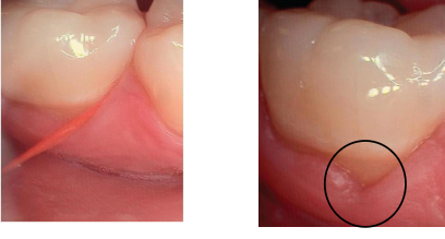 <p>gingival cleft (floss cuts)  created from not using the C-shape method of flossing; straight line cuts beginning at the gingival margin and may result if repeatedly injured</p><p>Causes: piece of floss that’s too long between fingers when held for insertion, or snapping floss forcefully, not curving the floss enough and cutting into gingival margin </p>