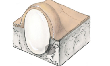 Cyst 