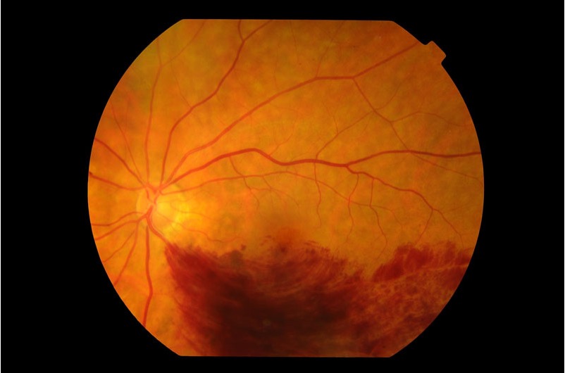 <p>What is the patient likely experiencing?</p><p></p><p>Sudden, painless, monocular loss of vision</p><p>The patient is diabetic and a smoker</p><p>Affected eye has gone blurry in the periphery</p><p>Affected eye does not demonstrate RAPD</p>