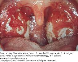 <p><strong>Symptoms of Infectious Mononucleosis</strong></p><p>-Malaise, fever, fatigue</p><p>-Severe sore throat with _________</p><p>-_________ cervical lymphadenopathy </p><p>-_____________ in 50-60% of patients, starts to resolve around 3rd week of illness. _________ is the most emergent complication of this, so tell patient to avoid contact sports for 4 weeks. </p>