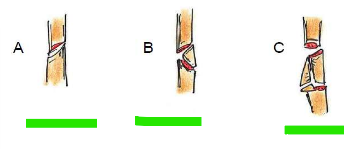 <p>Klassifikation nach Frakturtyp: Schaftbereich</p>
