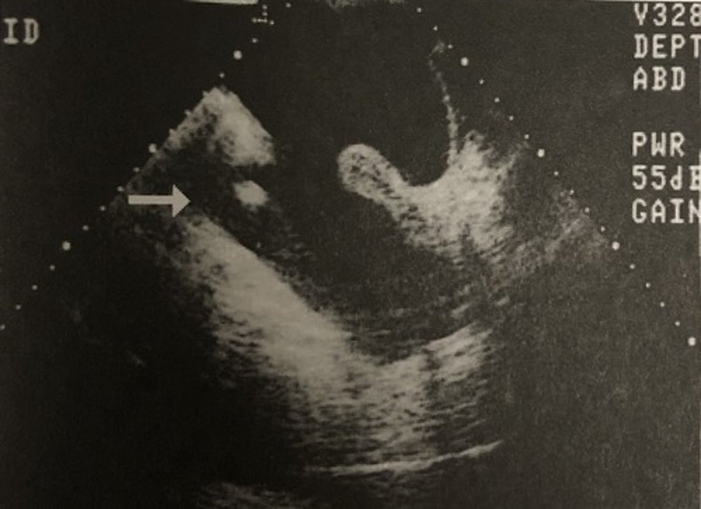 <p>640. The arrow in the image in question 639 is pointing to:</p><p>A. Slice-thickness artifact</p><p>B. Bowel</p><p>C. Side lobe artifact</p><p>D. Debris</p><p>E. Septation</p>