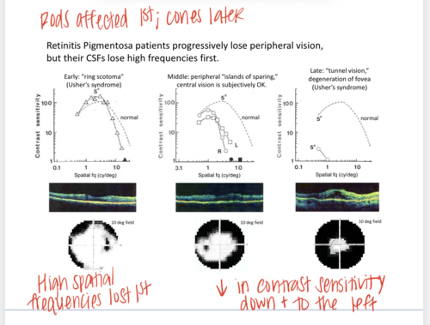 <p>Retinitis pigmentosa patients progressively lose peripheral vision. (High/med/low) spatial frequencies are lost first</p>