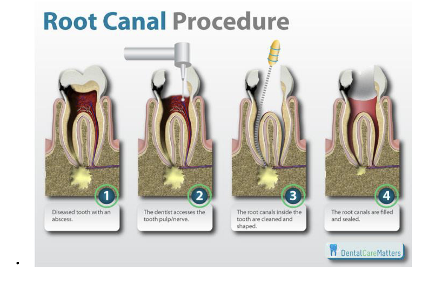 <p>1.  The tooth has an abscess.</p><p>2.  The dentist opens the tooth to reach the pulp/nerve.</p><p>3.  The dentist cleans and shapes the root canals inside the tooth.</p><p>4.  The root canals are filled and sealed.</p><p></p>