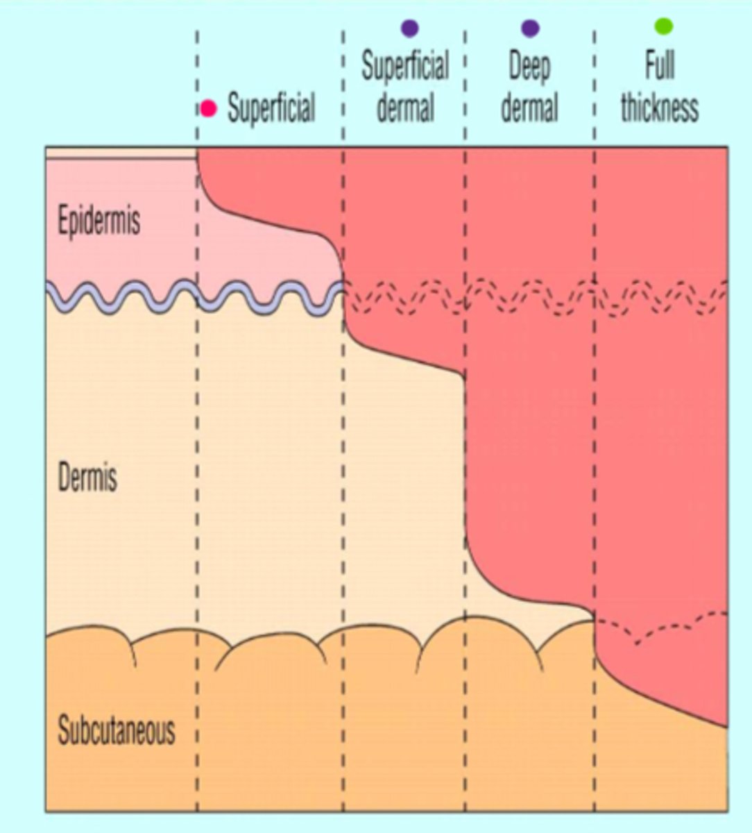 <p>1. Superficial ('epidermal')</p><p>2. Partial thickness (could be either 'superficial dermal' or 'deep dermal' involvement)</p><p>3. Full thickness</p><p>4. 4th degree</p><p>* not measured in degrees anymore except 4th degree</p>