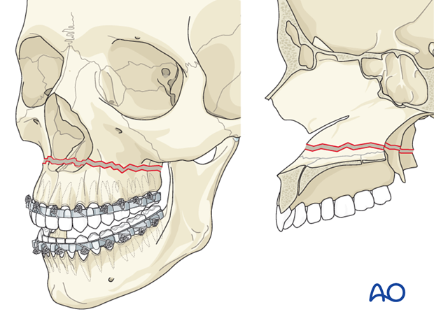 <p>a horizontal fracture through the pterygoid plates and maxillary bone between the hard palate and orbits</p>