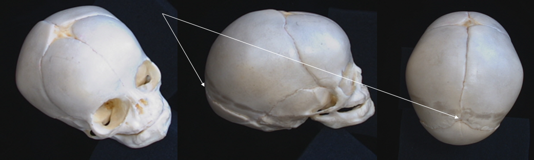 posterior fontanelle 