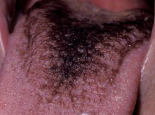 <p>brown/black excess keratin on surface of filiform papillae </p>
