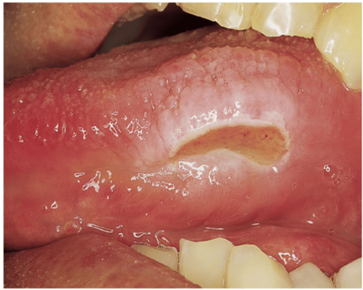 <p>trauma to mucosa</p>