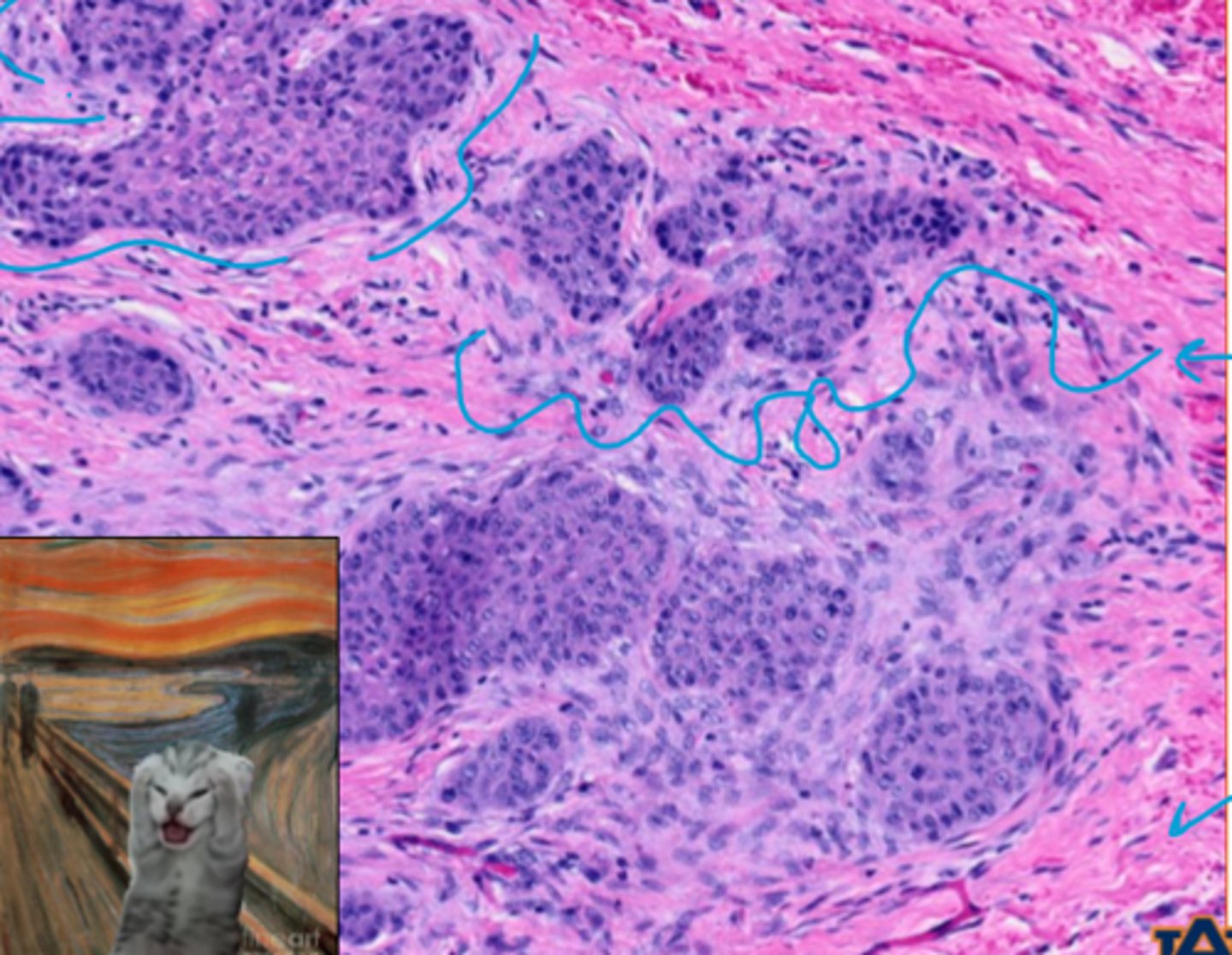 <p>What type of reaction is this?</p><p>What is the pink material around the outside?</p><p>What is the purple material surrounding the tumor islets??</p>