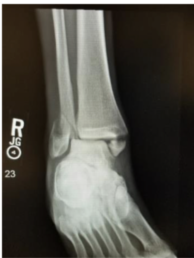 <p>A fracture of the medial malleolus and fibula</p>