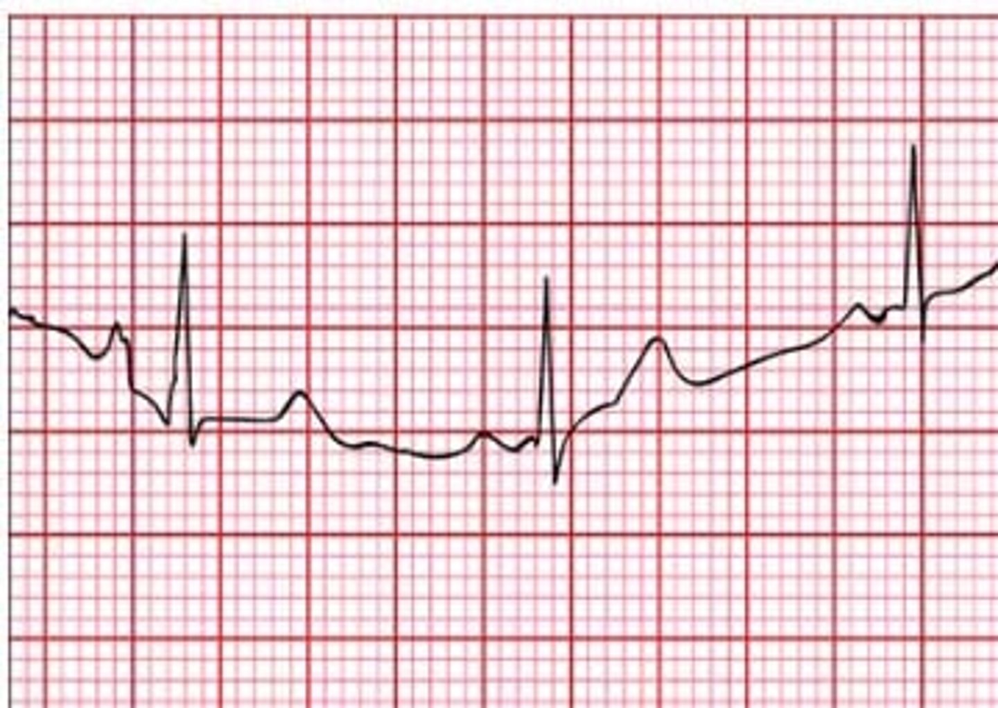 <p>Wandering baseline</p><p>A wandering baseline occurs when the stylus moves from the center of an EKG. This can be a result of too much lotion or sweat on the skin, an inadequate attachment to the skin, or additional reasons.</p>