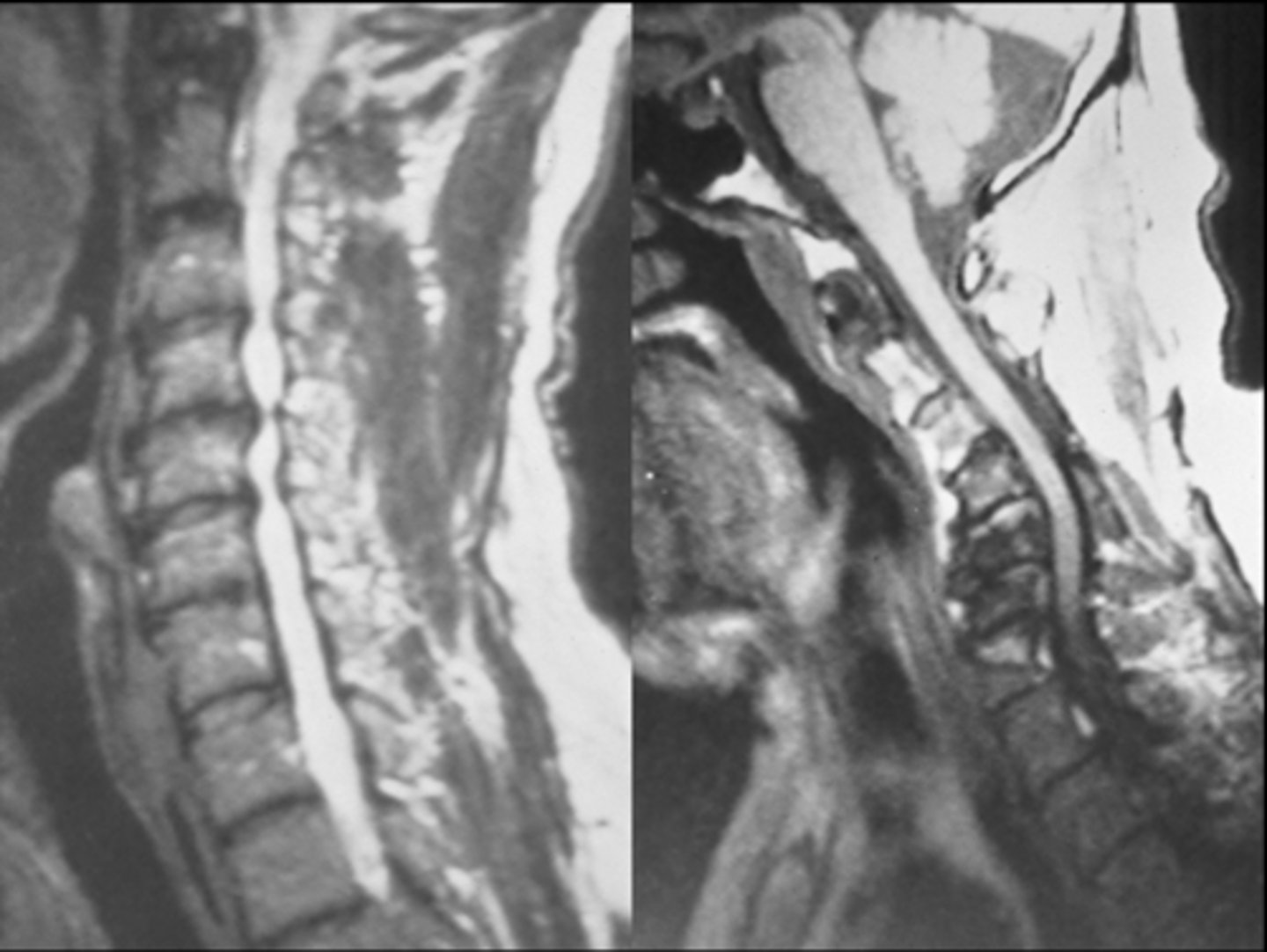 <p>ID type of degenerative spine disease</p>