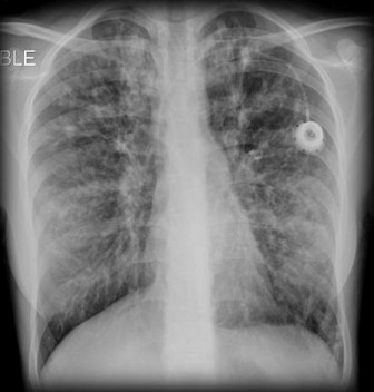 <p>Disorder associated with widespread dysfunction of the exocrine glands, abnormal secretion of sweat and saliva, and accumulation of thick mucus in the lungs</p>